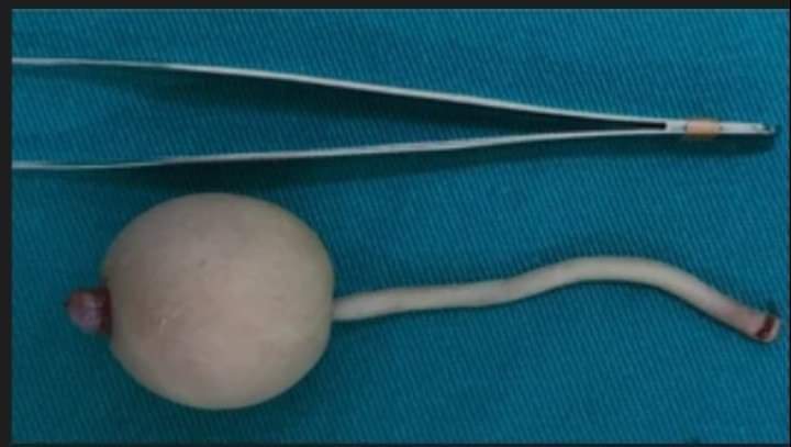 En Brasil nació un bebé con una cola de 12 centímetros