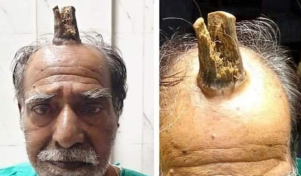 Sufrió un golpe en la cabeza y le creció durante años un «cuerno del diablo»