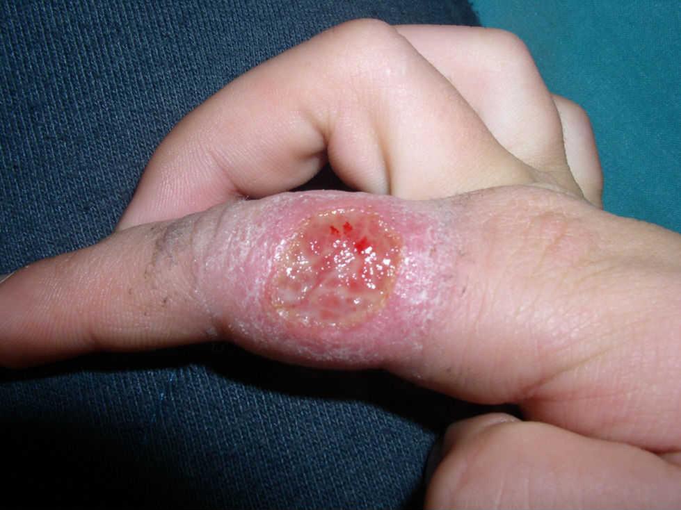 Tarija: Salud confirma 27 casos positivos de leishmaniasis en lo que va del año