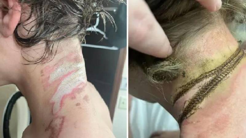 El cargador del celular hizo contacto con su collar y estuvo a punto de perder la vida